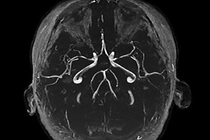 МРТ сосудов головы и шеи