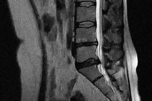 МРТ позвоночника