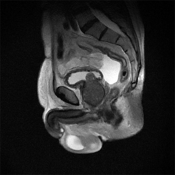 pelvis-5